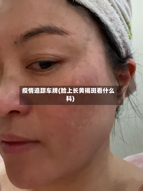 疫情追踪车牌(脸上长黄褐斑看什么科)-第2张图片