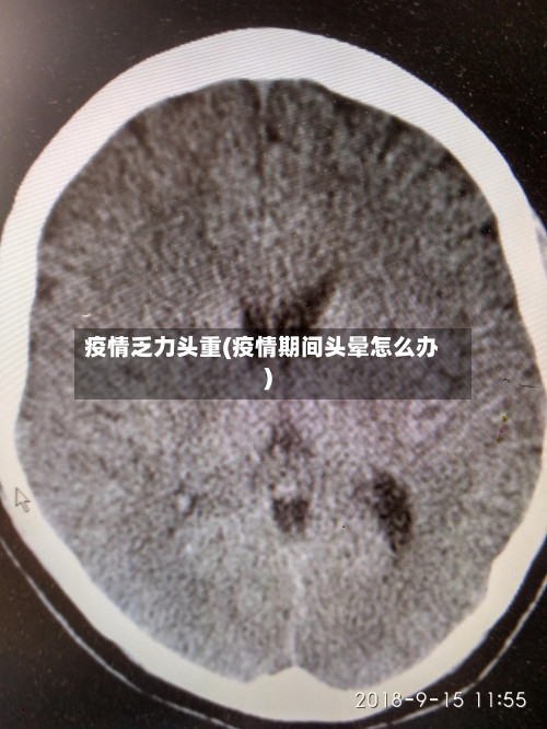 疫情乏力头重(疫情期间头晕怎么办)